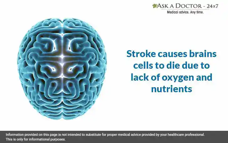 Stroke: Risk Factors, Warning Signs, And Things You Can Do To Prevent a Stroke