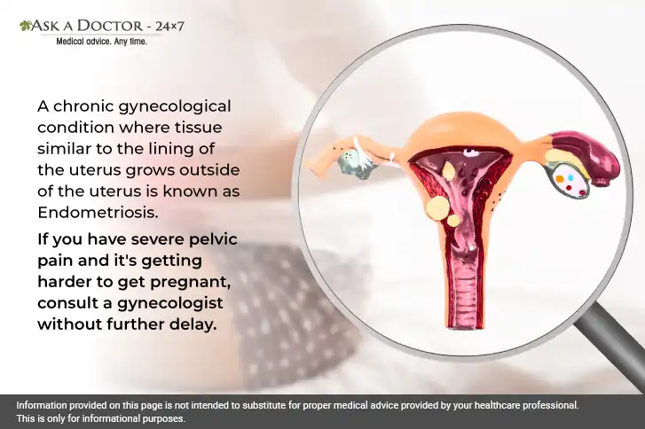 What is Endometriosis and How To Manage Endometriosis Relapse?