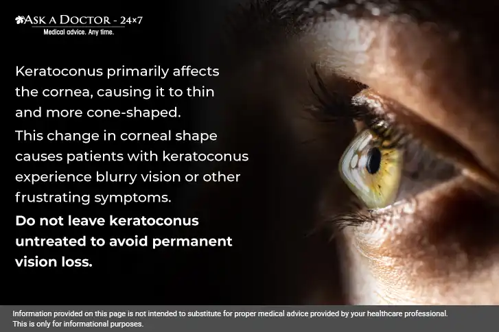 What You Should Know About Keratoconus