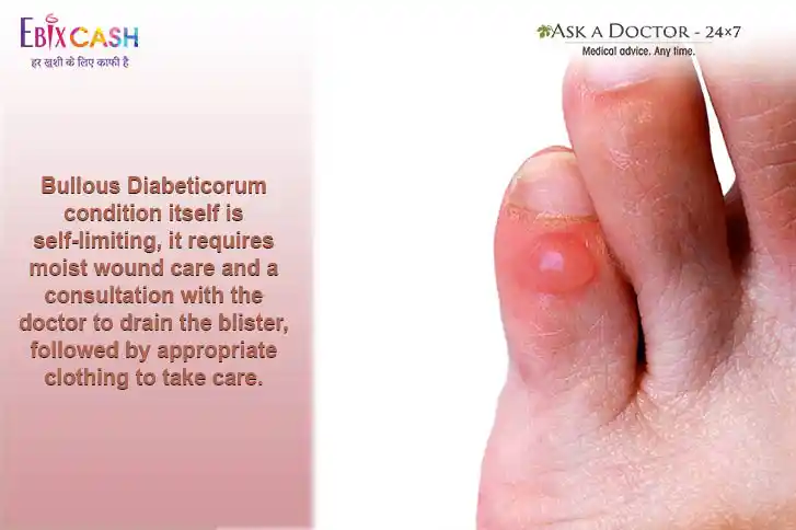 diabetic blisters on legs